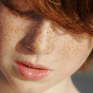 Taches de rousseur